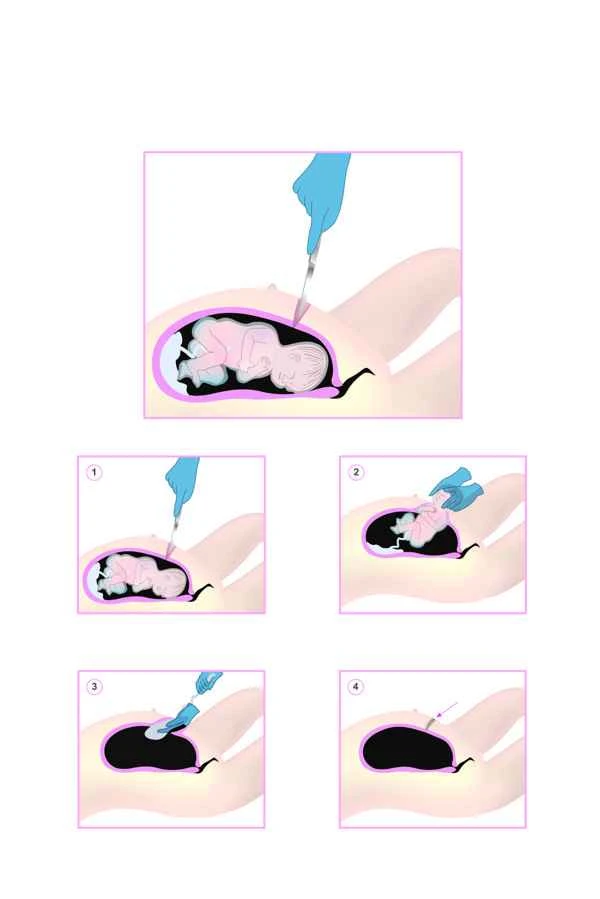 How to remove episiotomy scars