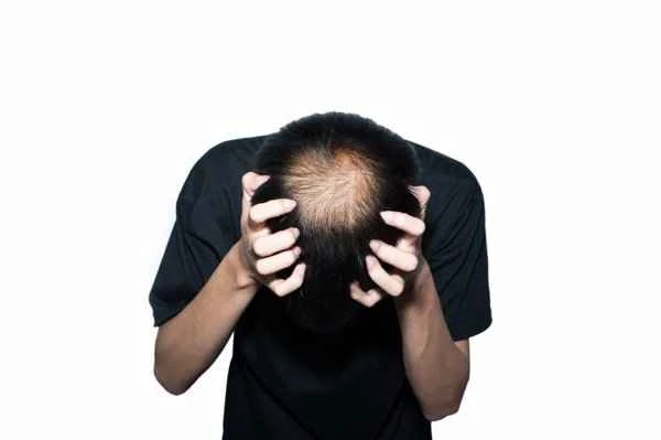 How to solve androgenetic alopecia?