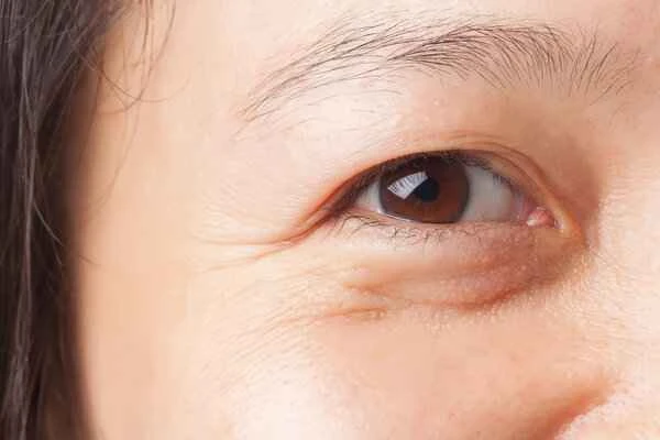 How to remove eye bags if you have keloid scarring