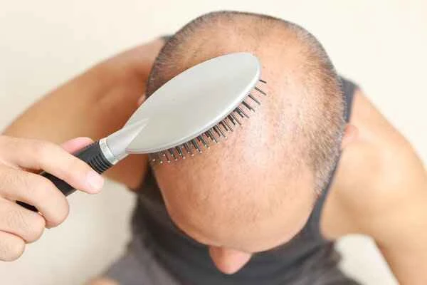How to diagnose male pattern baldness