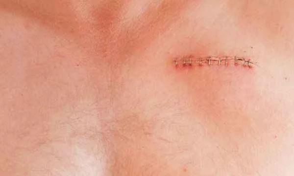 What happens if a tattoo is used to cover a scar on the chest?