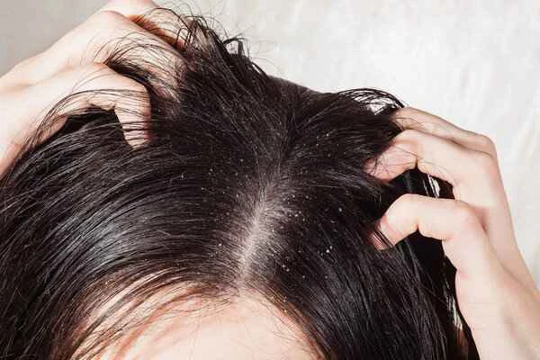 What's the best way to quickly remove dandruff?