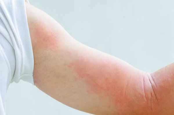 How to treat acute urticaria?
