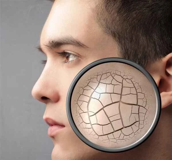 How to prevent vitiligo in spring