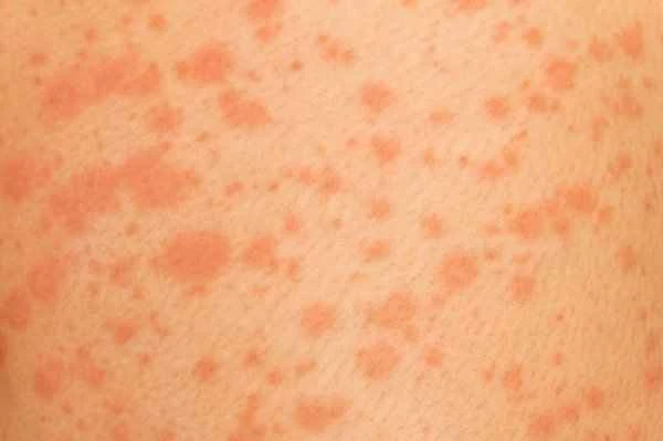 Can cholinergic urticaria be cured?