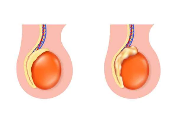 Does scrotal inflammation cause pain in the scrotum?