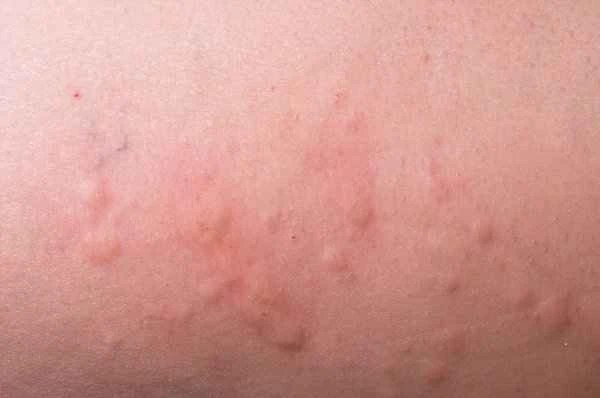 Is chronic urticaria contagious?