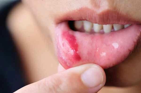 Can sunburned cheilitis be cured?