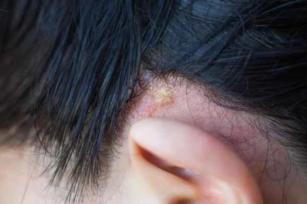 Does nasal seborrheic dermatitis cause hair loss?