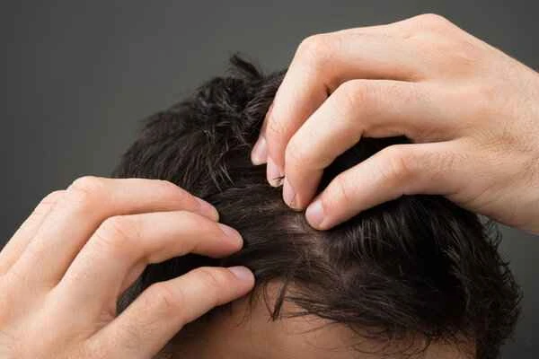 Is hair loss on the top of the head alopecia areata?