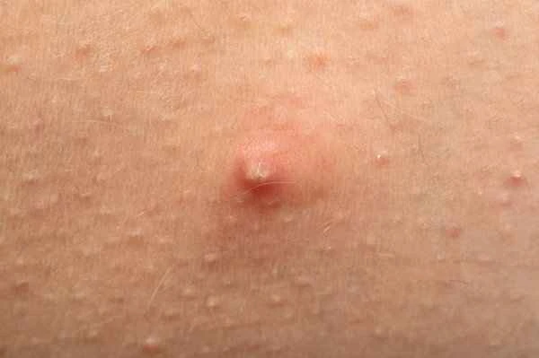 There are bumps and keloid scars under the armpits.