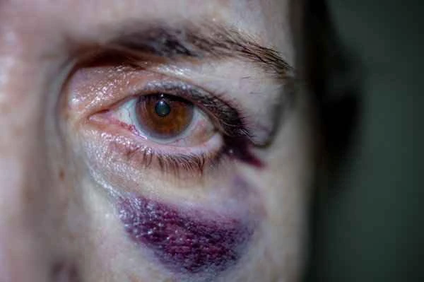 What causes the capillaries on the feet to turn purple?