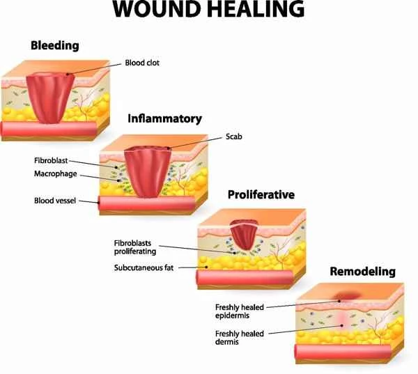 How to check if you have a tendency to form keloids?