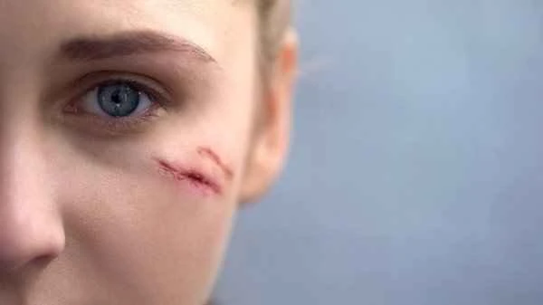 How to remove facial and neck scars