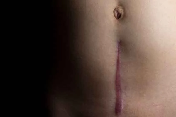 How to remove episiotomy scars