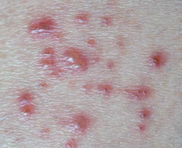 Will the shingles virus recur?