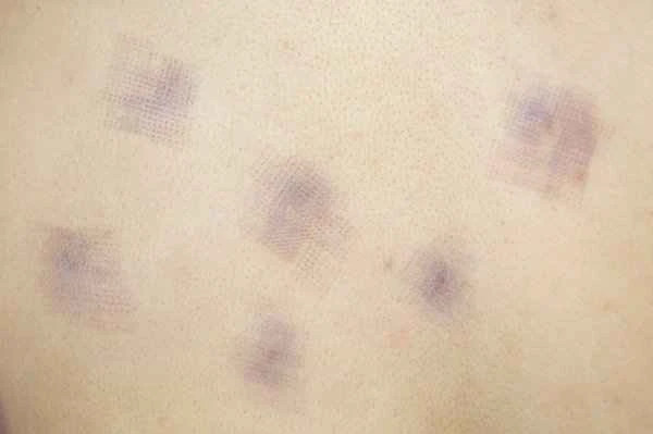 How to repair mole removal scars