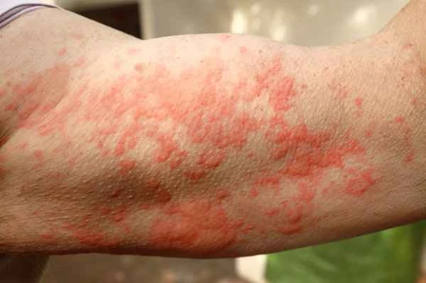 Can you die from chronic urticaria?