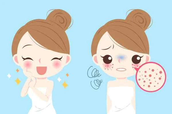 What diseases is seborrheic dermatitis related to?