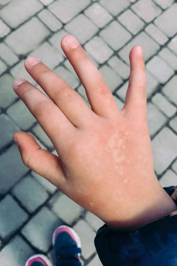 How to prevent vitiligo in spring
