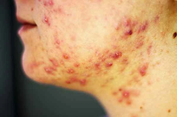 Is hives contagious in spring?