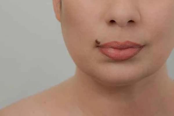 How to remove darkened mole removal scars?