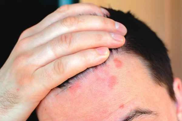 What to do about red scars left by acne?