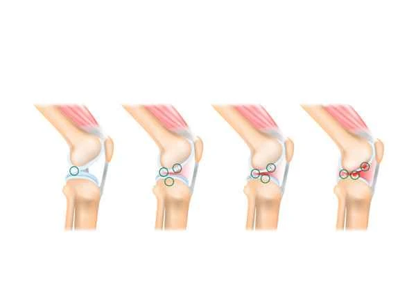 How to rehabilitate scar adhesions?