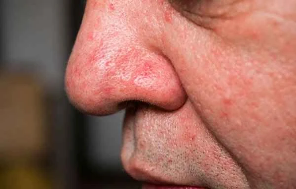 Does nasal seborrheic dermatitis cause hair loss?