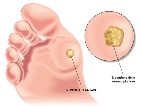 What are warts on the feet called?