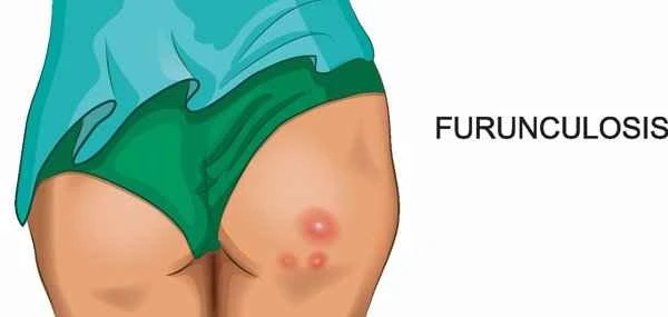 Does Baicao Cream treat scrotal eczema?