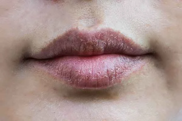 Is dry, chapped lips in winter a sign of cheilitis?
