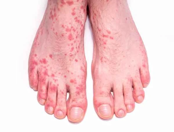 Can I take a bath if I have hives?