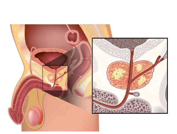 Scrotal folliculitis is most afraid of three things