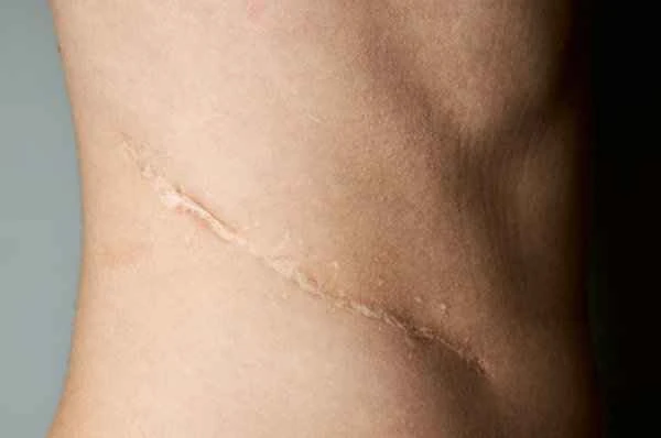 What to do about itchy and painful scars?