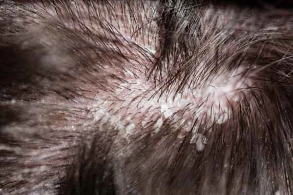 What can treat itchy scalp and dandruff?