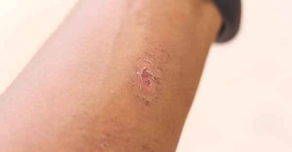 How to prevent it from becoming a scar