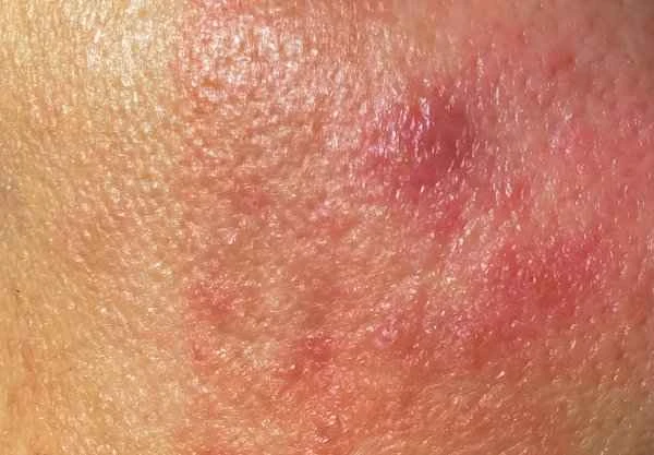 What to do about red, swollen, and itchy edges of cheilitis?