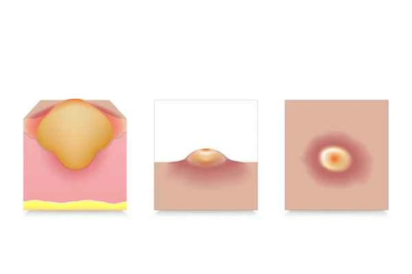 How to relieve itching from acne scars and keloids?